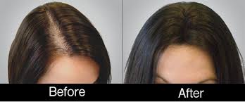 PRP-Stem-cell-therapy-hair