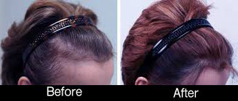 hair-loss-PRP-stem-cell-before-after